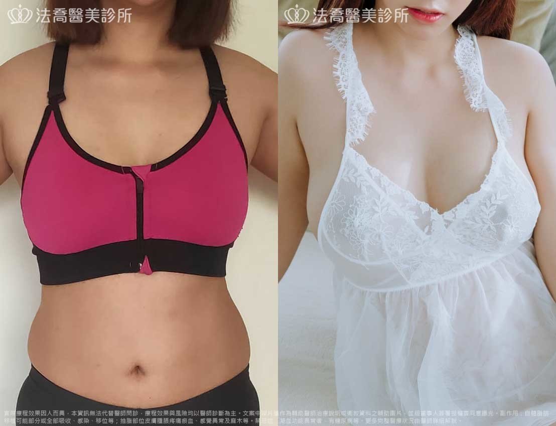 法喬醫美診所,邱浚彥,自體脂肪豐胸,威塑抽脂