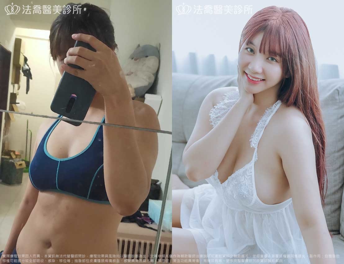 法喬醫美診所,邱浚彥,自體脂肪豐胸,威塑抽脂