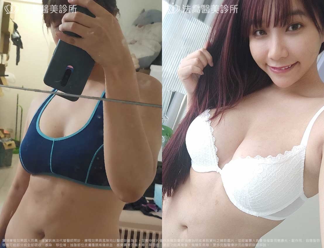 法喬醫美診所,邱浚彥,自體脂肪豐胸,威塑抽脂