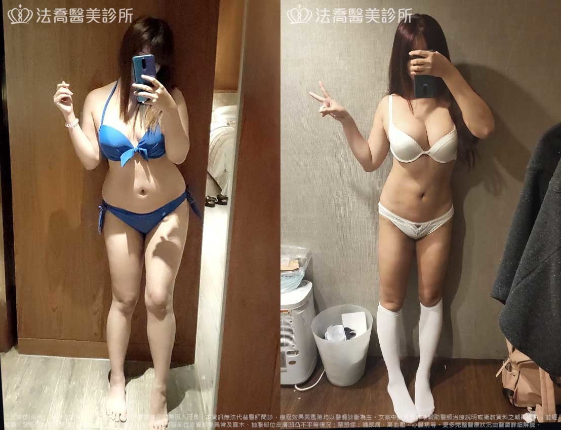 法喬醫美診所,邱浚彥,威塑抽脂
