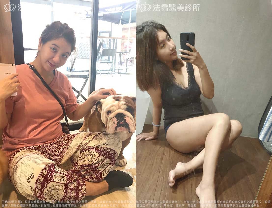 法喬醫美診所,邱浚彥,威塑抽脂