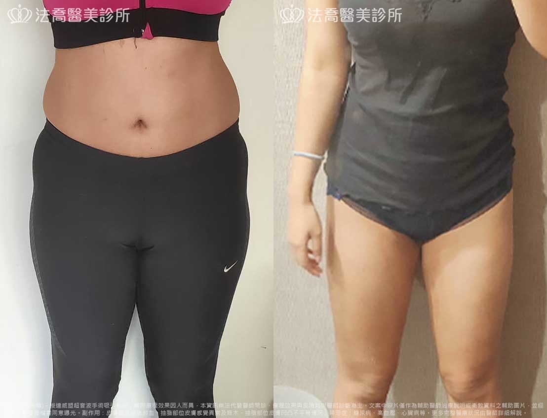 法喬醫美診所,邱浚彥,自體脂肪豐胸,威塑抽脂