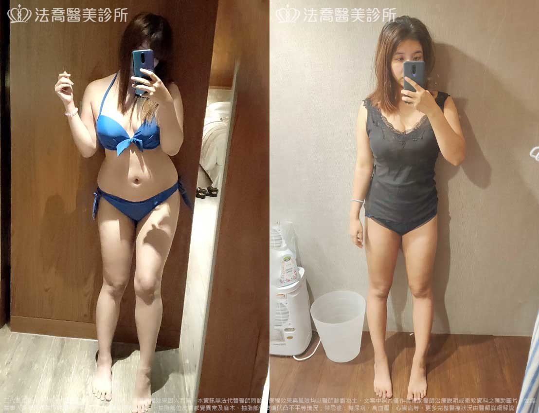 法喬醫美診所,邱浚彥,威塑抽脂