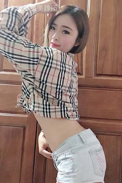 自體肋骨隆鼻