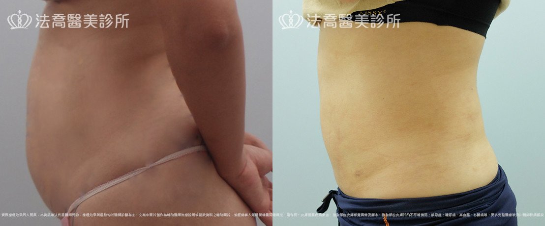 法喬醫美診所,邱浚彥,腹部環抽