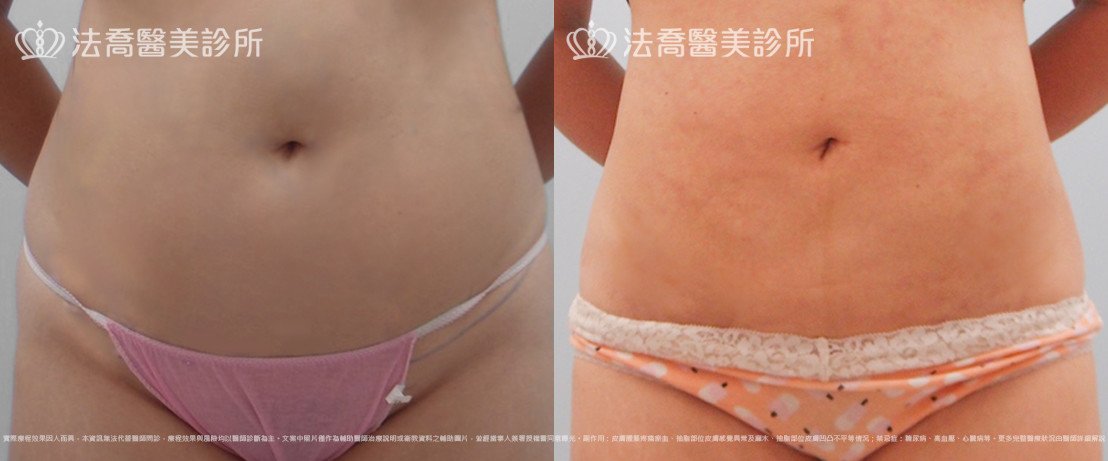 法喬醫美診所,邱浚彥,腹部環抽