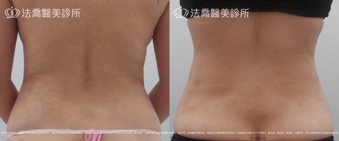 法喬醫美診所,邱浚彥,腹部環抽