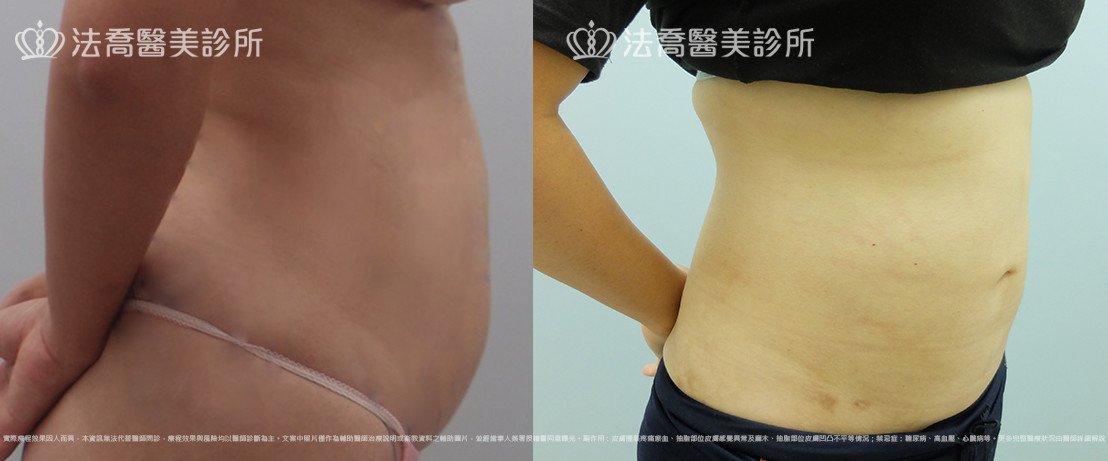 法喬醫美診所,邱浚彥,腹部環抽