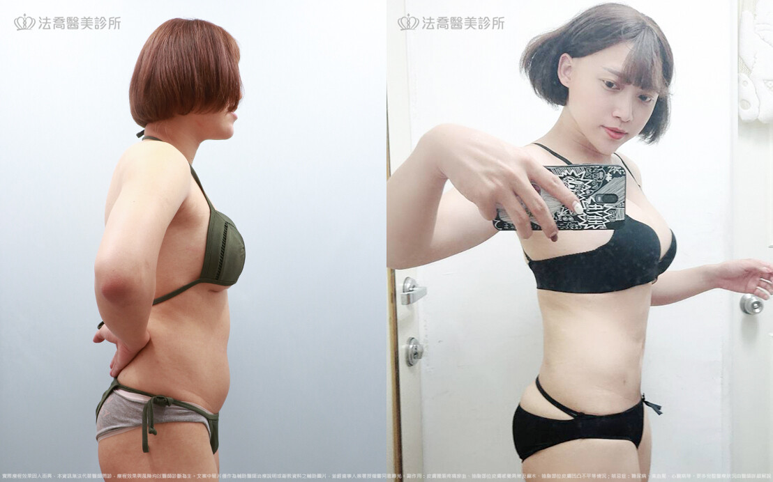 威塑腹部環抽