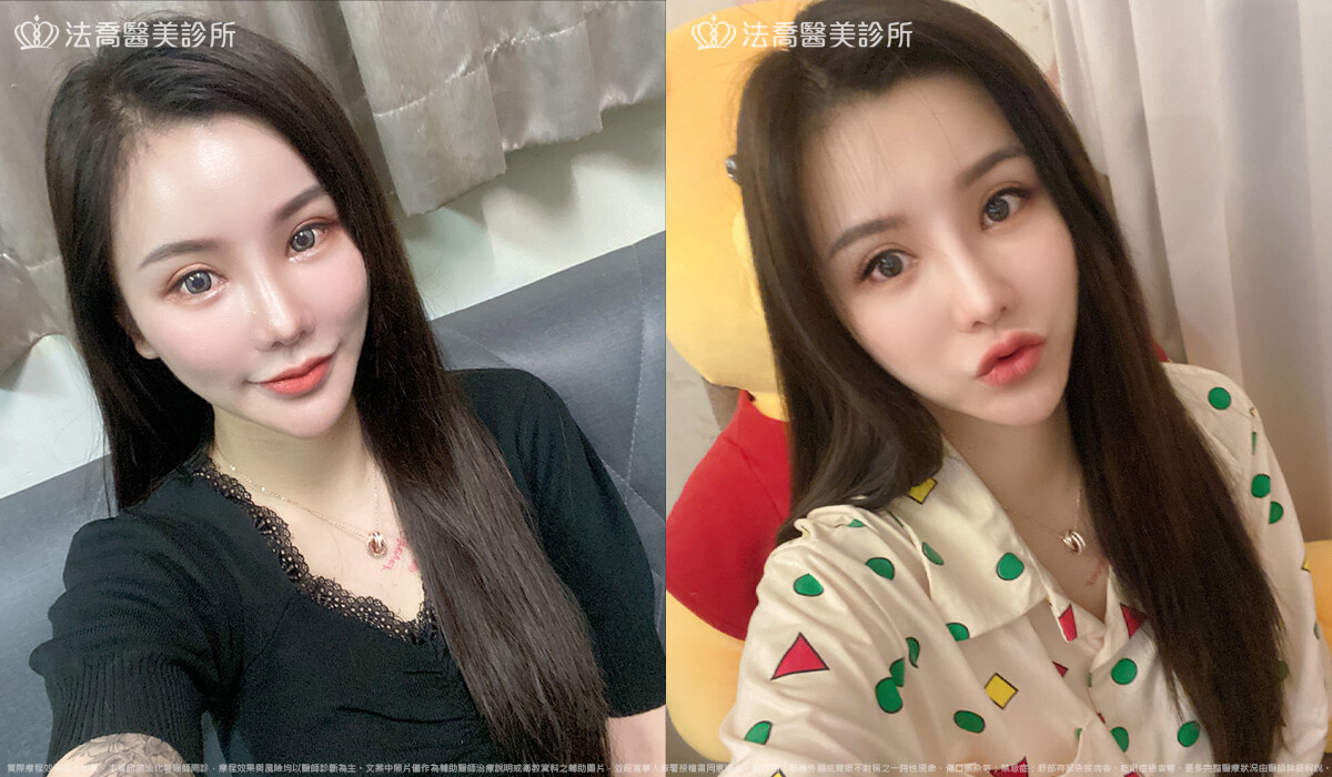 開眼頭、開眼尾、眼尾下置術