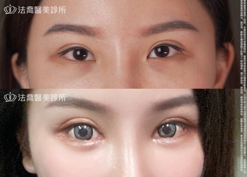 開眼頭、開眼尾、眼尾下置術