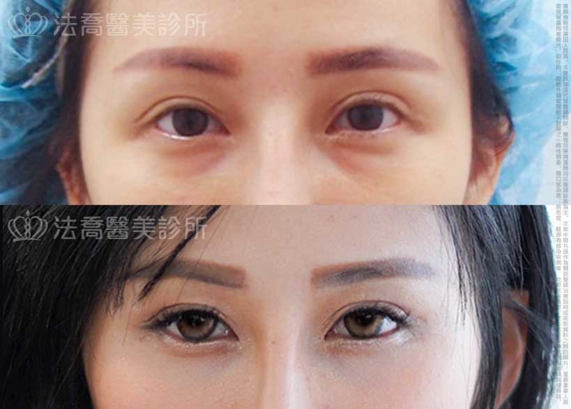 法喬醫美診所,邱浚彥,眼袋內開