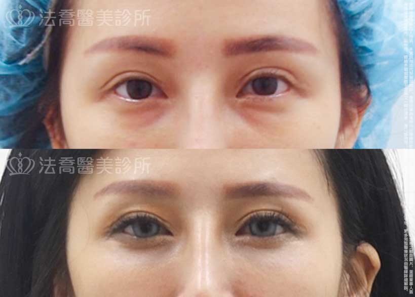 法喬醫美診所,邱浚彥,眼袋內開