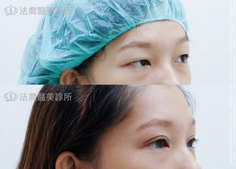 眼部手術