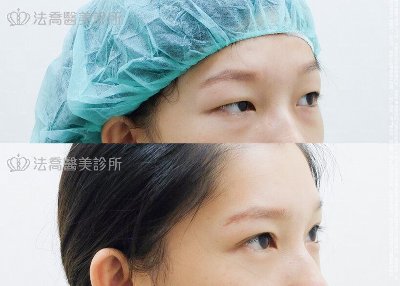 割雙眼皮