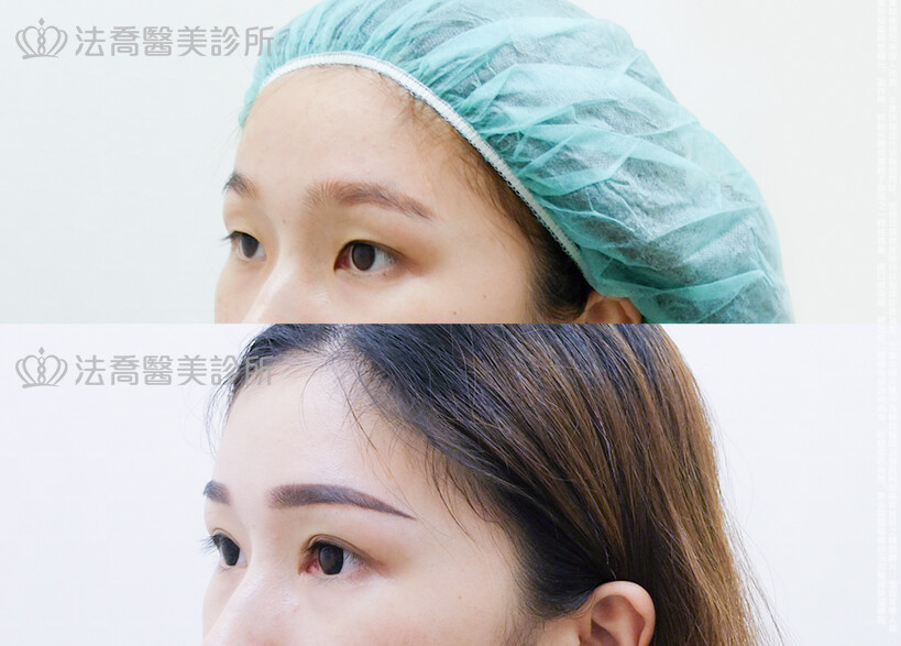 眼部手術