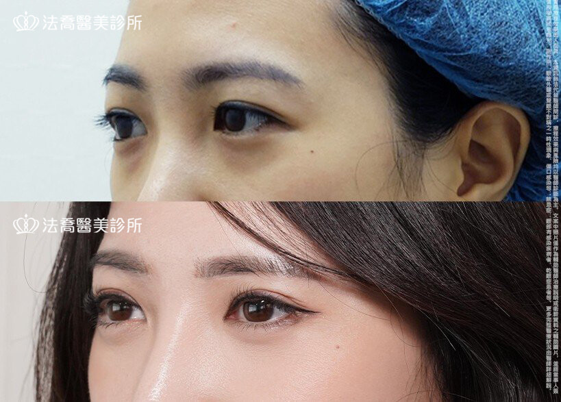 眼袋內開、切眉 / 術前與術後6個月