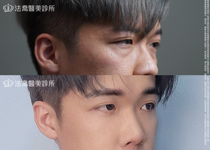 眼袋內開、脂肪移位 術前與術後3個月