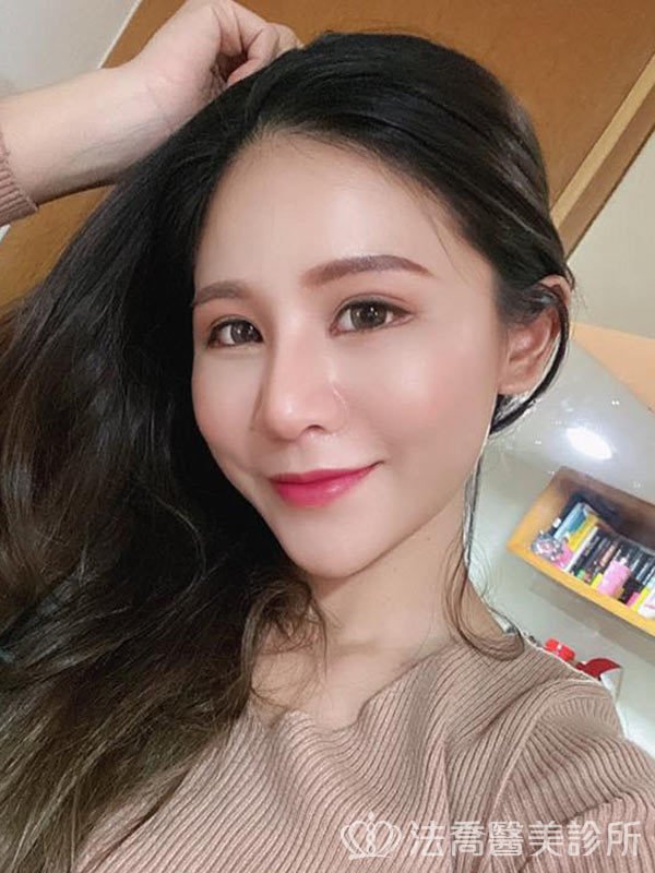 自體肋骨隆鼻