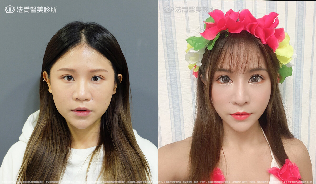 法喬醫美診所,邱浚彥,自體肋骨隆鼻