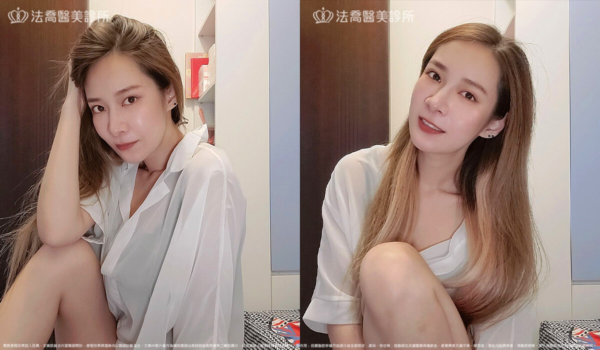 眼袋內開 脂肪移位 術後一個月 生活照