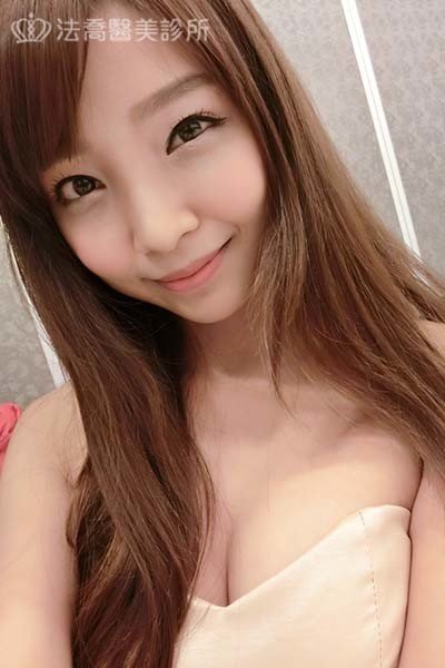 自體肋骨隆鼻