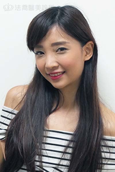 自體肋骨隆鼻