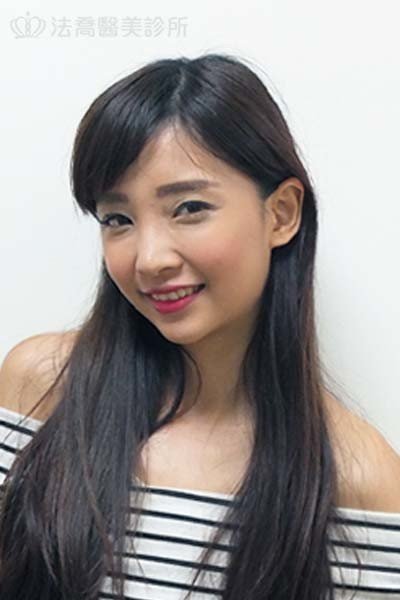 自體肋骨隆鼻