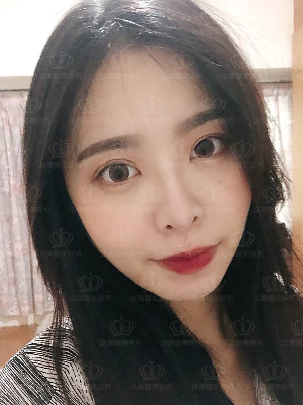 法喬醫美診所_蕭邦割雙眼皮合併提眼瞼肌+開眼頭開眼尾+眼尾下置_術後20天