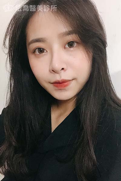 法喬醫美診所 邱浚彥醫師 自體肋骨隆鼻