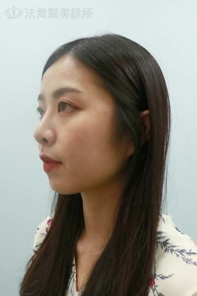 法喬醫美診所 邱浚彥醫師 自體肋骨隆鼻