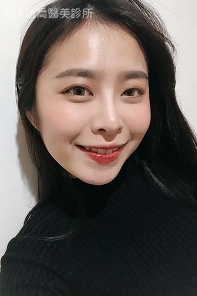 法喬醫美診所 邱浚彥醫師 自體肋骨隆鼻