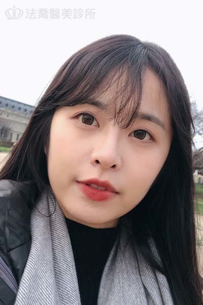 法喬醫美診所 邱浚彥醫師 自體肋骨隆鼻