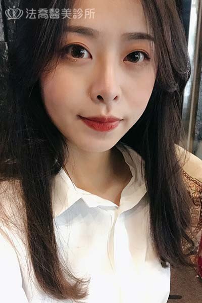 法喬醫美診所 邱浚彥醫師 自體肋骨隆鼻