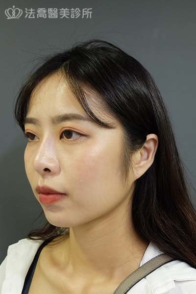 法喬醫美診所 邱浚彥醫師 自體肋骨隆鼻