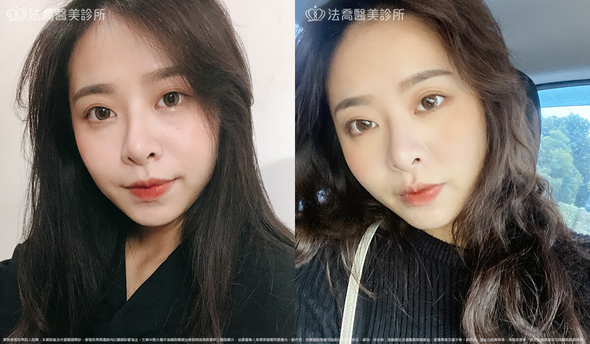 法喬醫美診所,邱浚彥,割雙眼皮