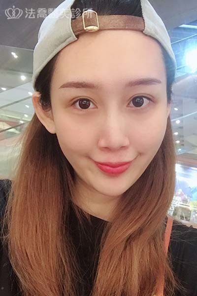 自體肋骨隆鼻