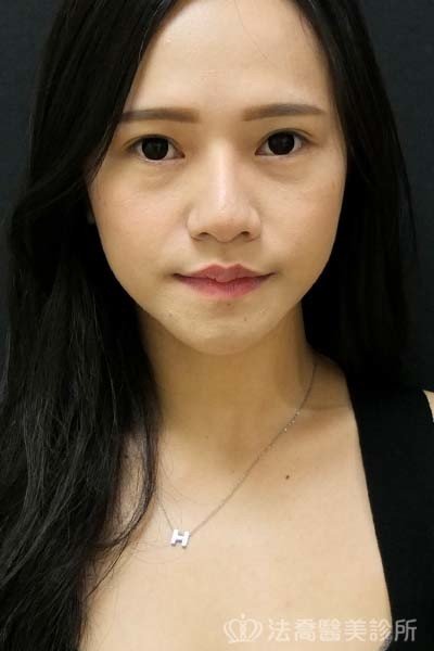 法喬醫美診所_童桂妃割雙眼皮合併提眼瞼肌+開眼頭開眼尾_術前