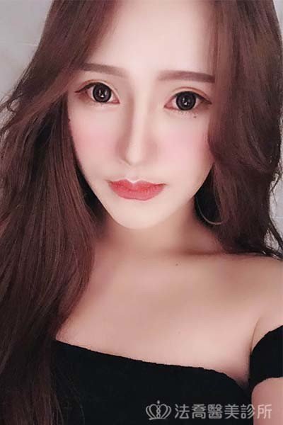 法喬醫美診所_童桂妃割雙眼皮合併提眼瞼肌+開眼頭開眼尾_術後9個月