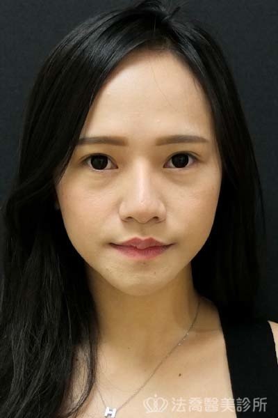 法喬醫美診所_童桂妃割雙眼皮合併提眼瞼肌+開眼頭開眼尾_術前