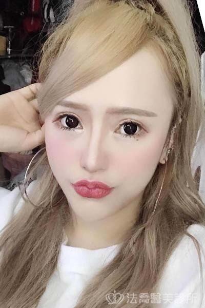 法喬醫美診所_童桂妃割雙眼皮合併提眼瞼肌+開眼頭開眼尾_術後9個月