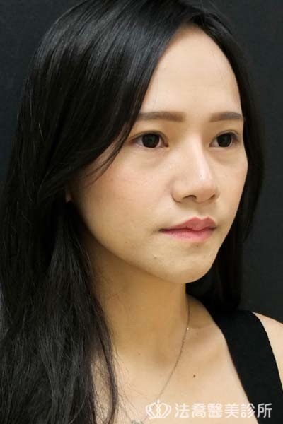 法喬醫美診所_童桂妃割雙眼皮合併提眼瞼肌+開眼頭開眼尾_術前