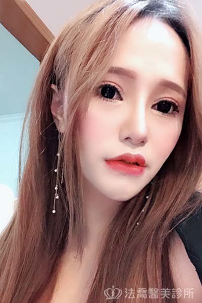 法喬醫美診所_童桂妃割雙眼皮合併提眼瞼肌+開眼頭開眼尾_術後6個月