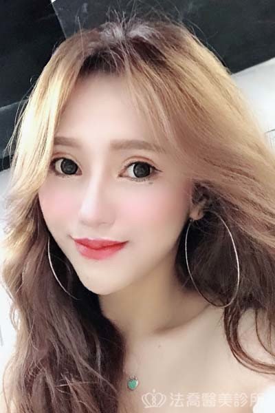 法喬醫美診所_童桂妃割雙眼皮合併提眼瞼肌+開眼頭開眼尾_術後6個月