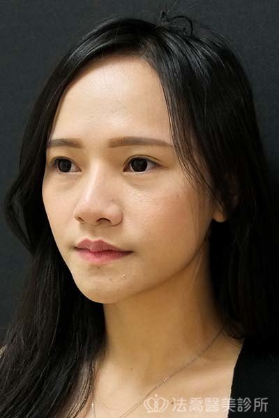 法喬醫美診所_童桂妃割雙眼皮合併提眼瞼肌+開眼頭開眼尾_術前