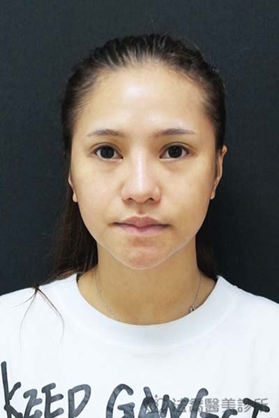 法喬醫美診所_童桂妃割雙眼皮合併提眼瞼肌+開眼頭開眼尾_術後4個月