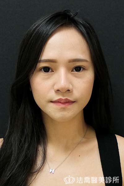 法喬醫美診所_童桂妃割雙眼皮合併提眼瞼肌+開眼頭開眼尾_術前