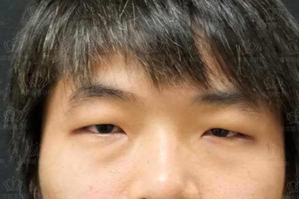 法喬醫美診所_男生_罐子_大眼術前案例