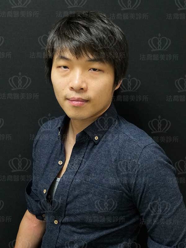 法喬醫美診所_男生_罐子_大眼術前案例
