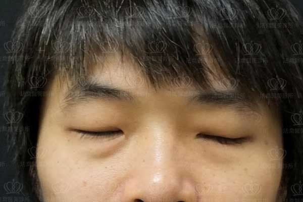 法喬醫美診所_男生_罐子_大眼術前案例